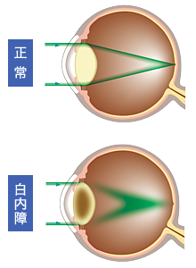 2焦点レンズと3焦点眼内レンズの見え方のシミュレーション